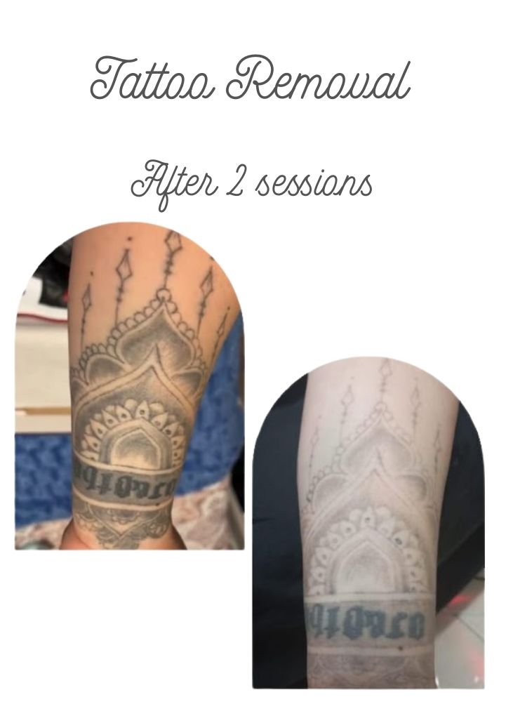 Tattoo removal results